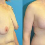 Breast Augmentation & Lift #3 - Before and After