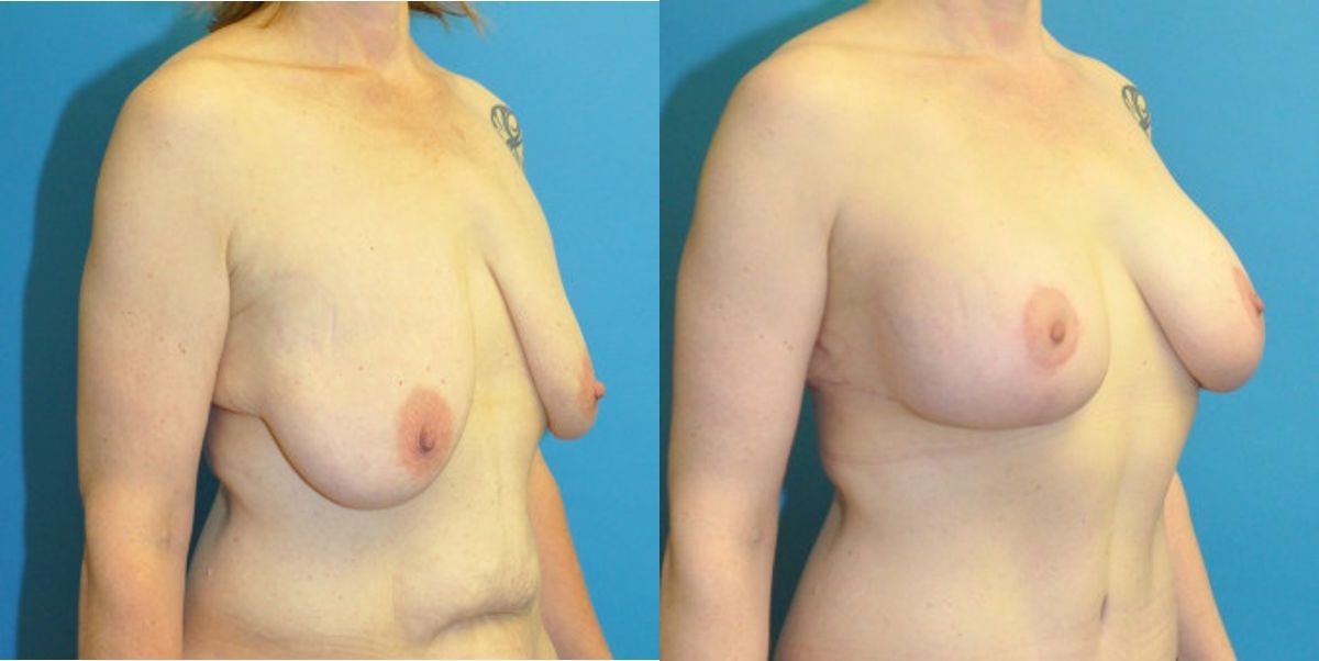 Breast Augmentation & Lift #3 - Before and After