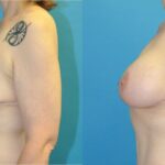Breast Augmentation & Lift #3 - Before and After