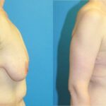 Breast Augmentation & Lift #3 - Before and After
