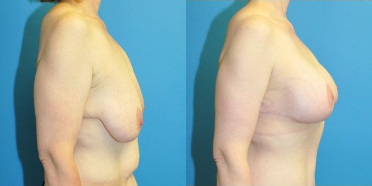 Breast Augmentation & Lift #3 - Before and After