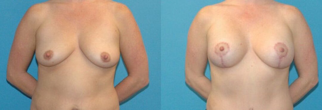 Breast Augmentation & Lift #4