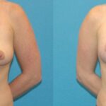 Breast Augmentation & Lift #4 - Before and After