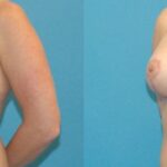 Breast Augmentation & Lift #4 - Before and After