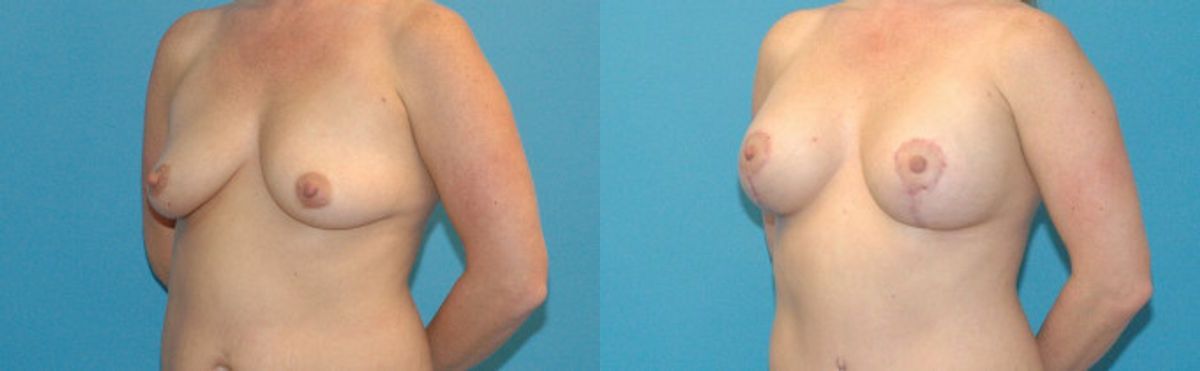 Breast Augmentation & Lift #4 - Before and After