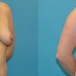 Breast Augmentation & Lift #4 - Before and After