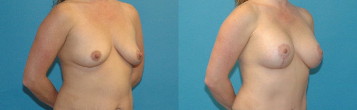 Breast Augmentation & Lift #4 - Before and After