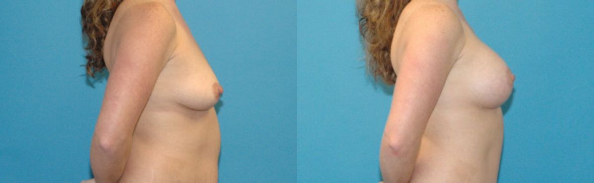 Breast Augmentation & Lift #4 - Before and After