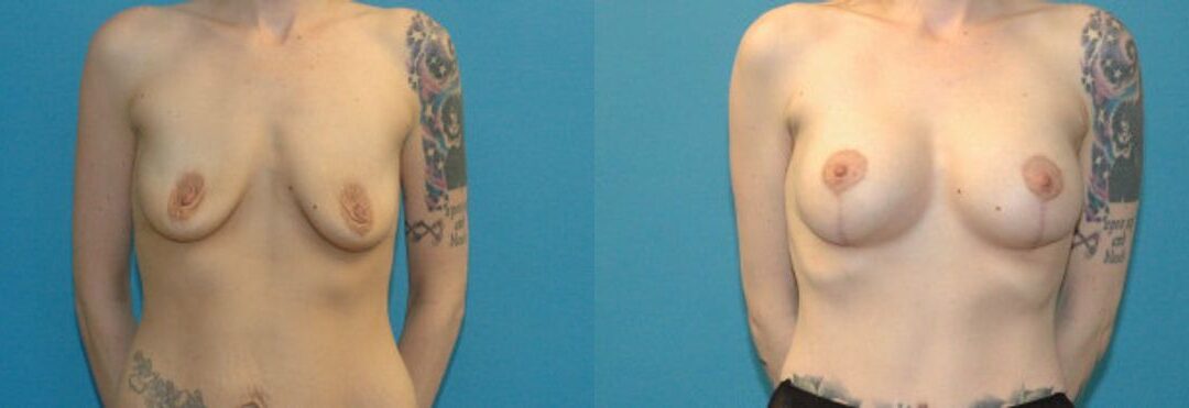 Breast Augmentation & Lift #5