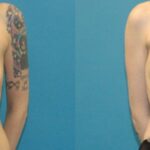 Breast Augmentation & Lift #5 - Before and After