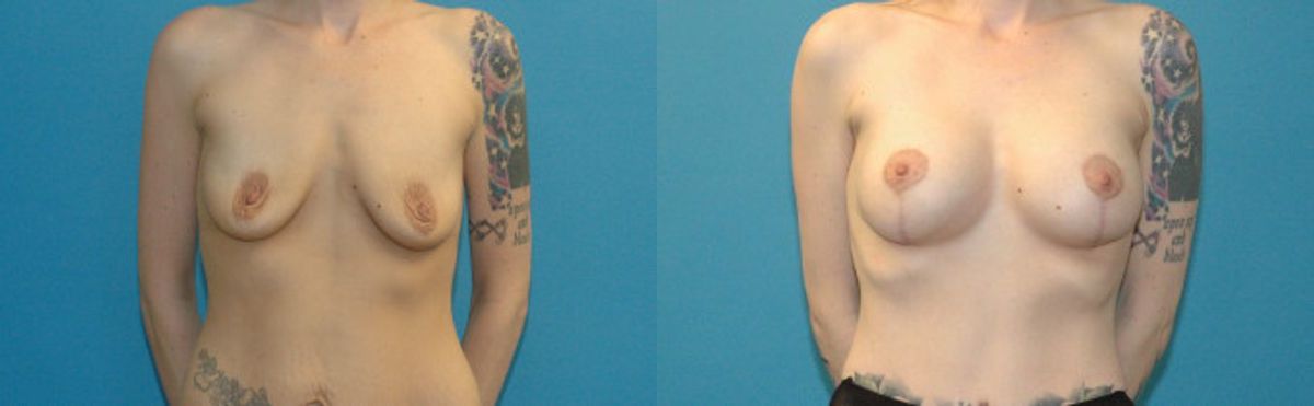 Breast Augmentation & Lift #5 - Before and After