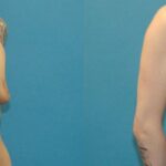 Breast Augmentation & Lift #5 - Before and After
