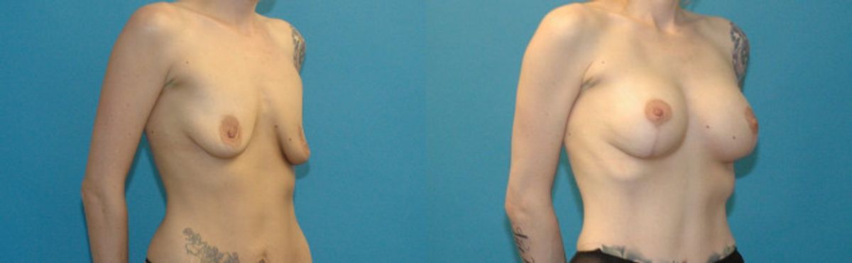 Breast Augmentation & Lift #5 - Before and After