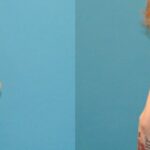 Breast Augmentation & Lift #5 - Before and After
