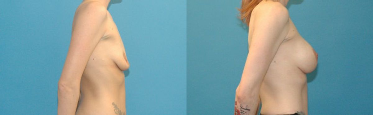 Breast Augmentation & Lift #5 - Before and After
