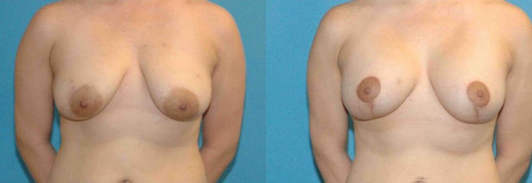 Breast Augmentation & Lift #9