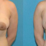 Breast Augmentation & Lift #9 - Before and After