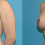 Breast Augmentation & Lift #9 - Before and After