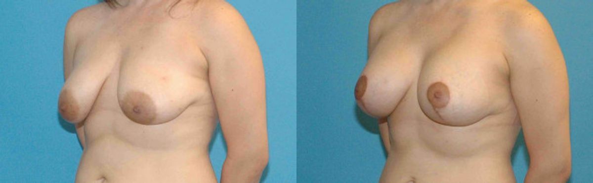 Breast Augmentation & Lift #9 - Before and After