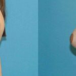 Breast Augmentation & Lift #9 - Before and After