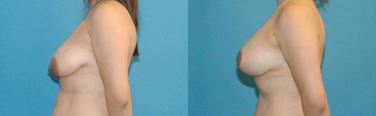 Breast Augmentation & Lift #9 - Before and After