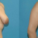 Breast Augmentation & Lift #9 - Before and After