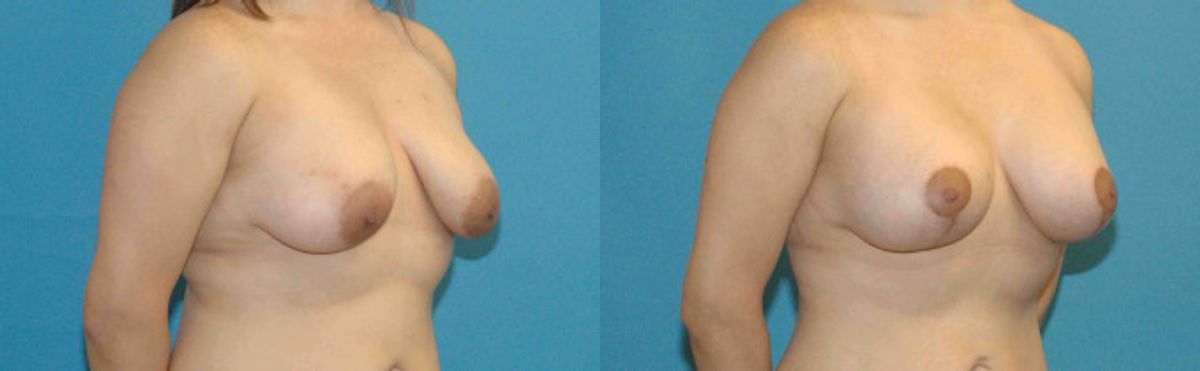 Breast Augmentation & Lift #9 - Before and After