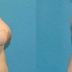 Breast Augmentation & Lift #9 - Before and After