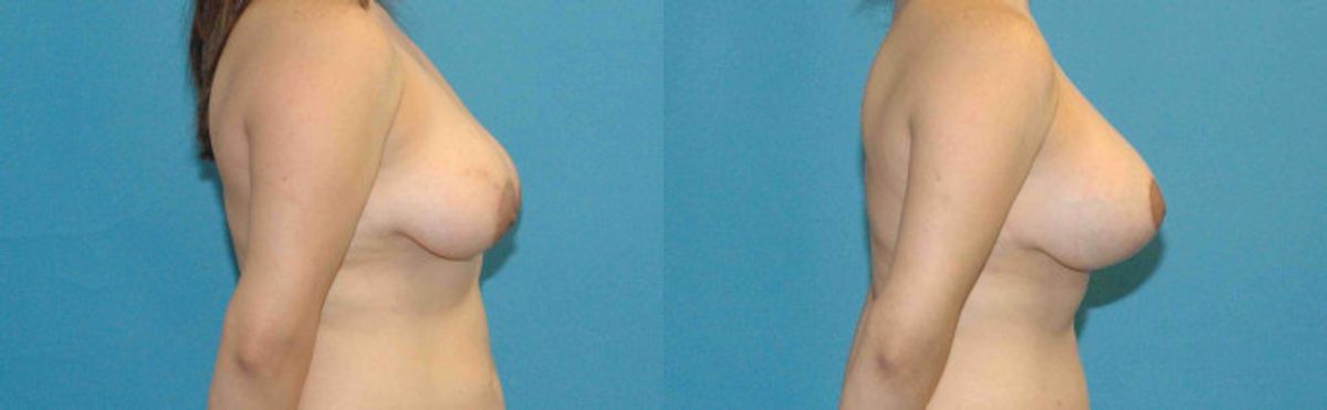 Breast Augmentation & Lift #9 - Before and After