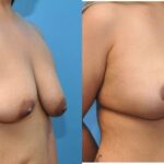 Breast Augmentation & Lift #10 - Before and After