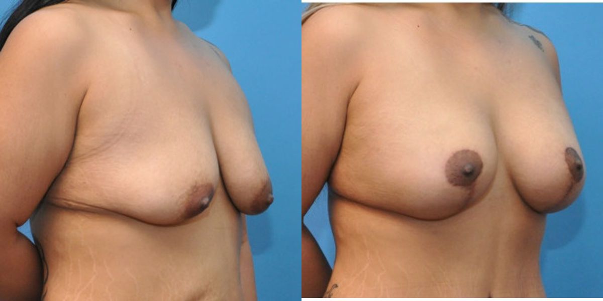 Breast Augmentation & Lift #10 - Before and After