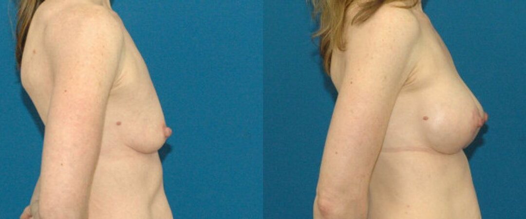 Breast Augmentation & Lift #11