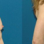 Breast Augmentation & Lift #11 - Before and After