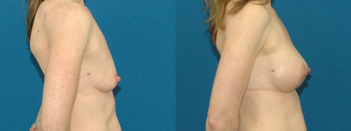 Breast Augmentation & Lift #11 - Before and After