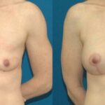 Breast Augmentation & Lift #11 - Before and After