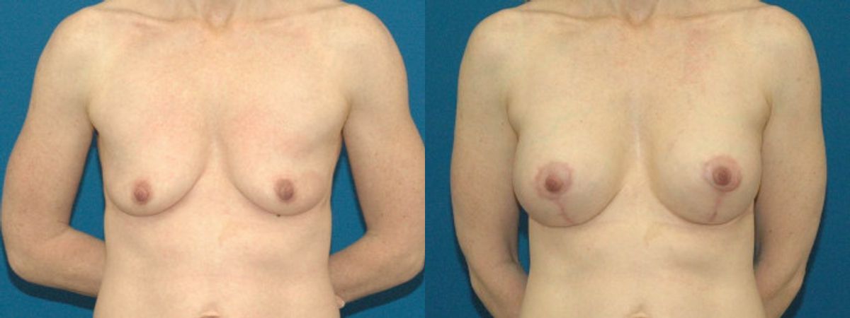 Breast Augmentation & Lift #11 - Before and After