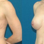Breast Augmentation & Lift #11 - Before and After