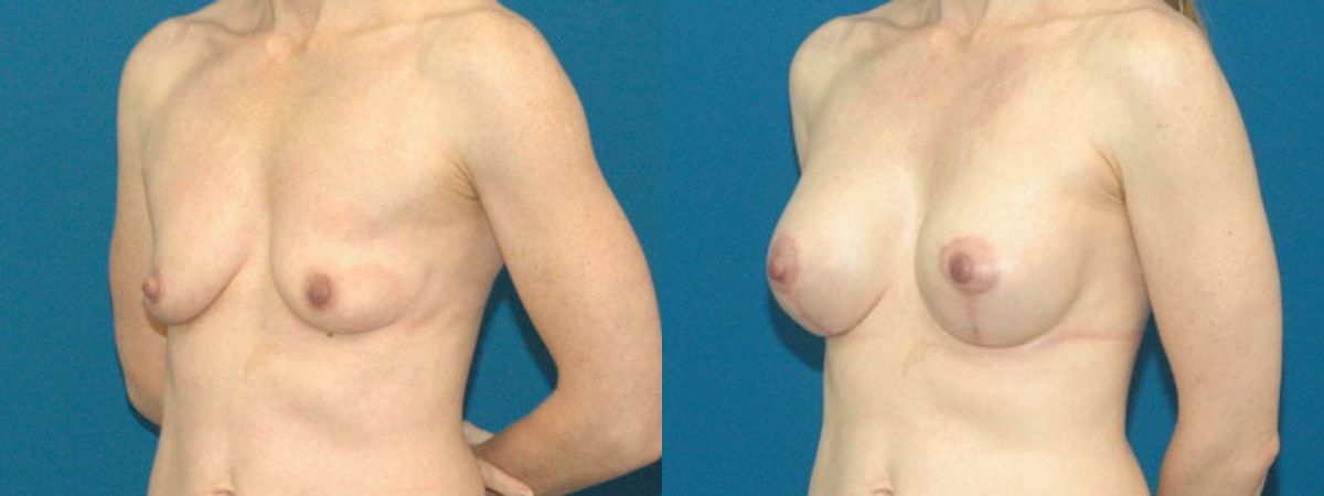 Breast Augmentation & Lift #11 - Before and After