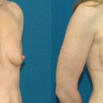 Breast Augmentation & Lift #11 - Before and After