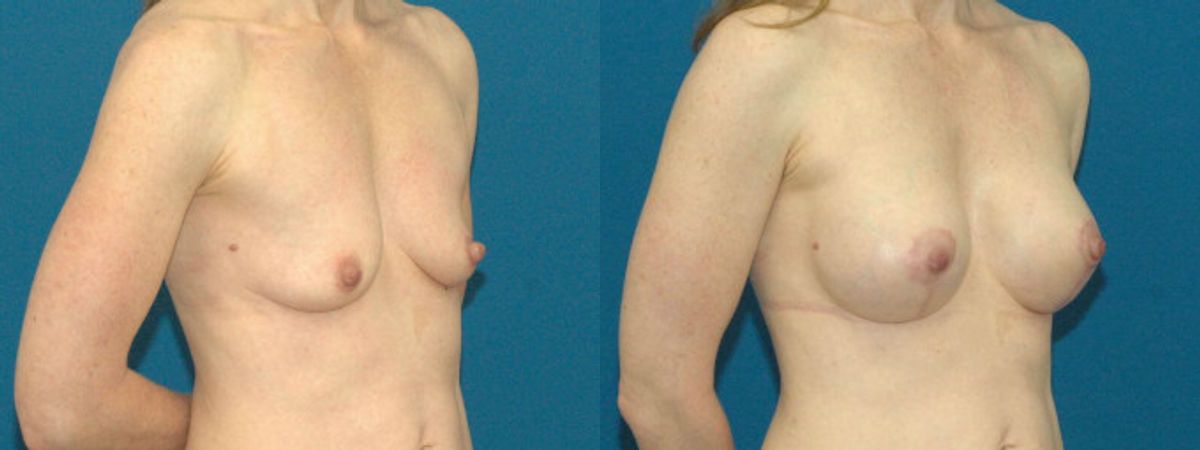 Breast Augmentation & Lift #11 - Before and After