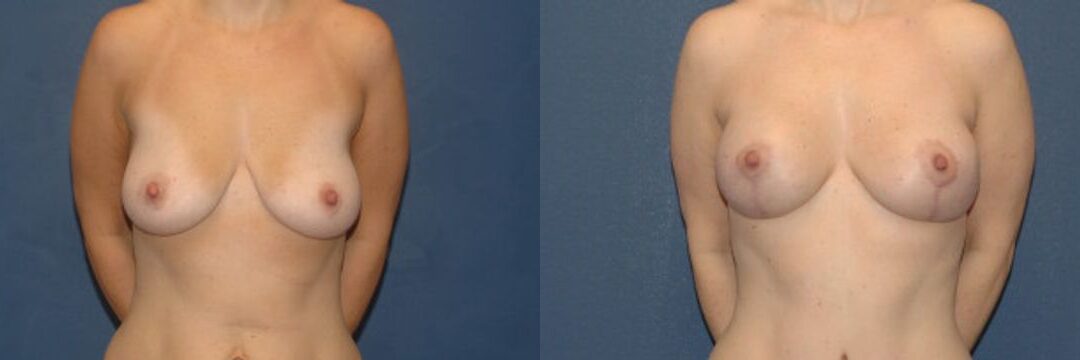 Breast Augmentation & Lift #12