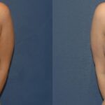 Breast Augmentation & Lift #12 - Before and After