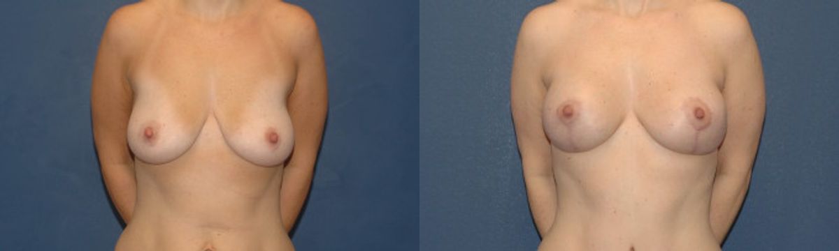 Breast Augmentation & Lift #12 - Before and After
