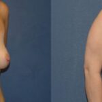 Breast Augmentation & Lift #12 - Before and After