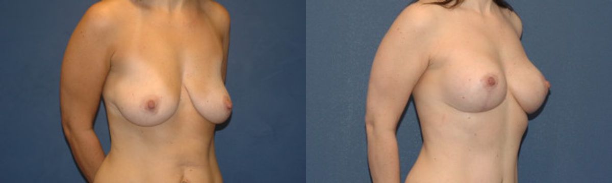 Breast Augmentation & Lift #12 - Before and After