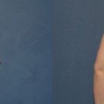 Breast Augmentation & Lift #12 - Before and After