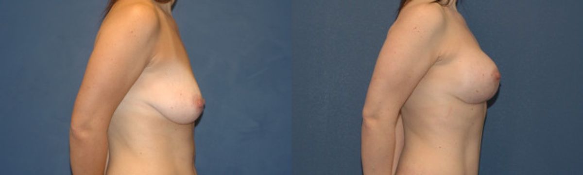 Breast Augmentation & Lift #12 - Before and After