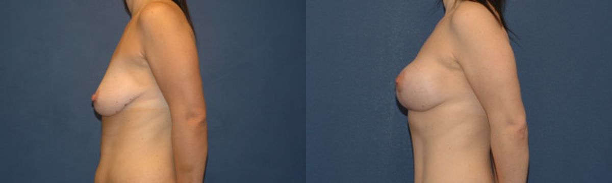 Breast Augmentation & Lift #12 - Before and After