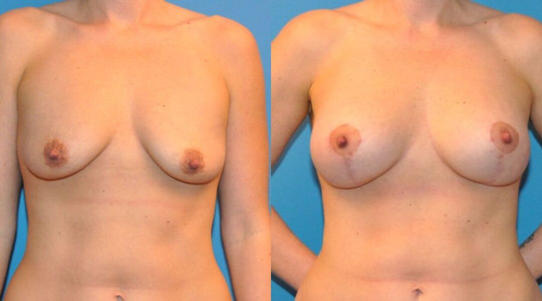 Breast Augmentation & Lift #13