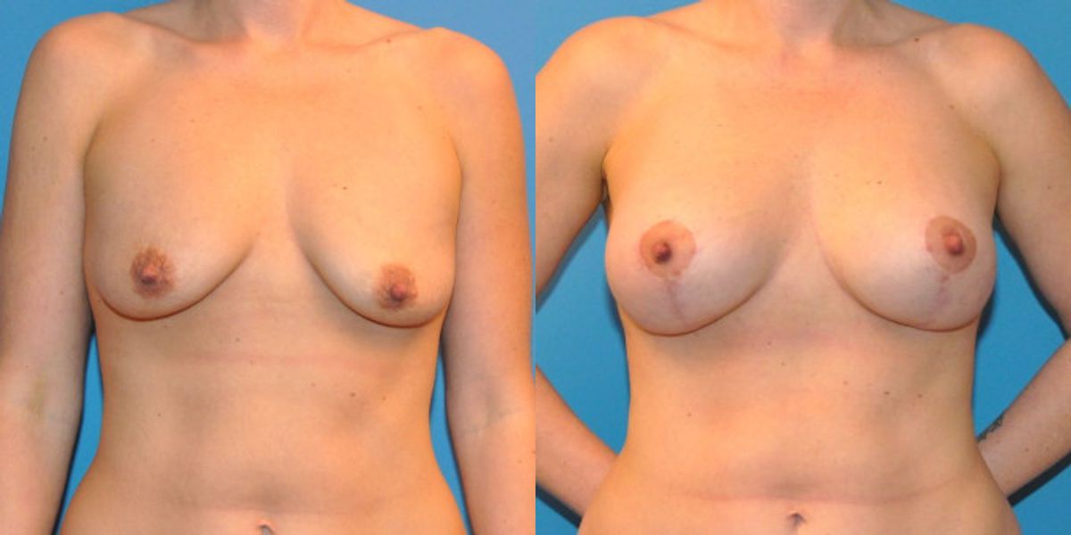 Breast Augmentation & Lift #13 - Before and After
